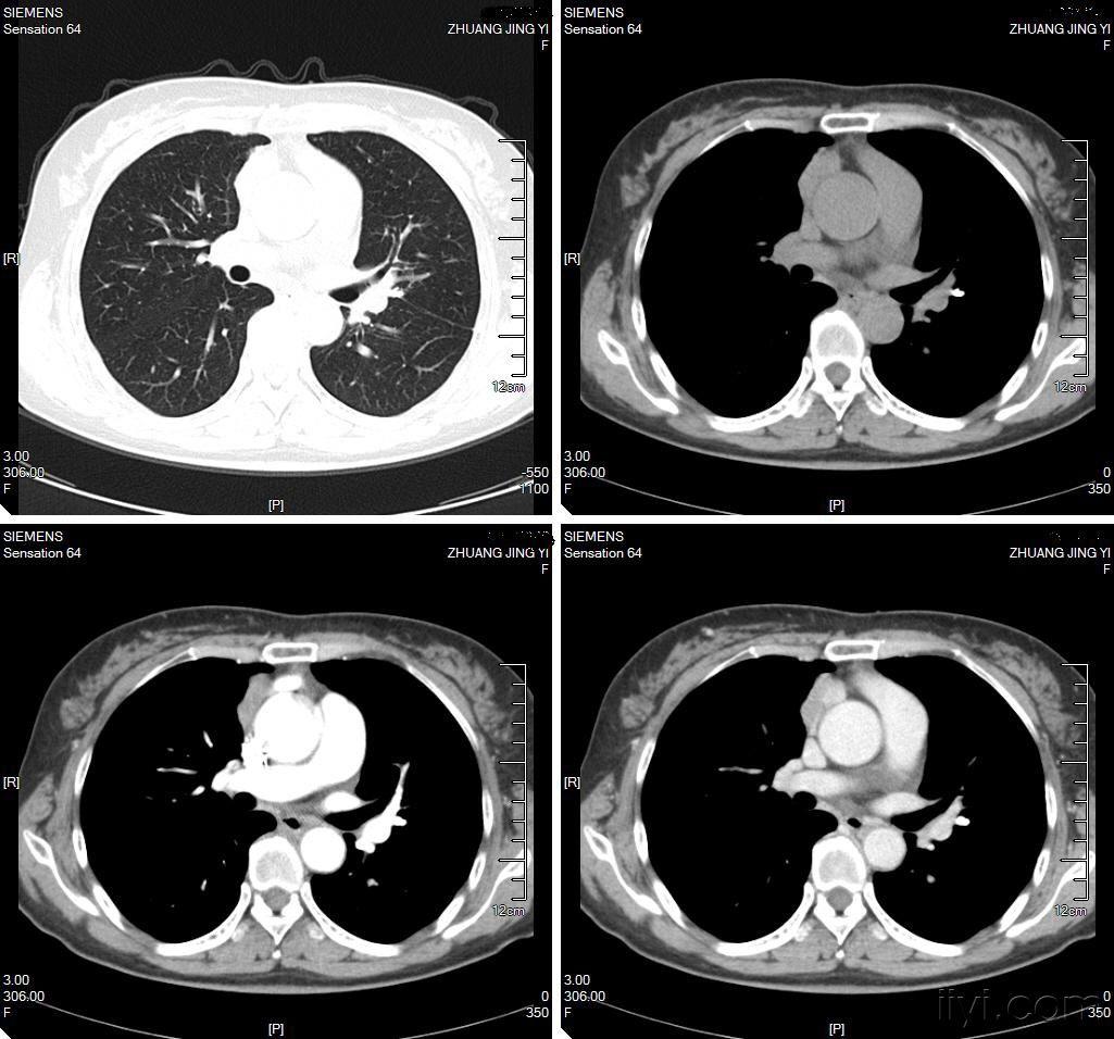 胸部ct平扫增强病理四天后公布