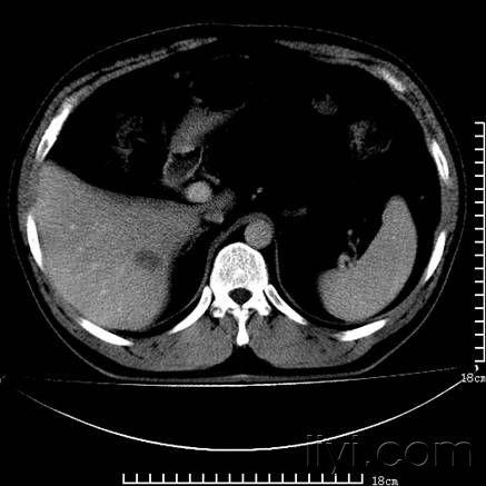 请大家分析肝脏低密度影