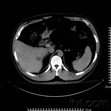 肝右叶低密度灶图片