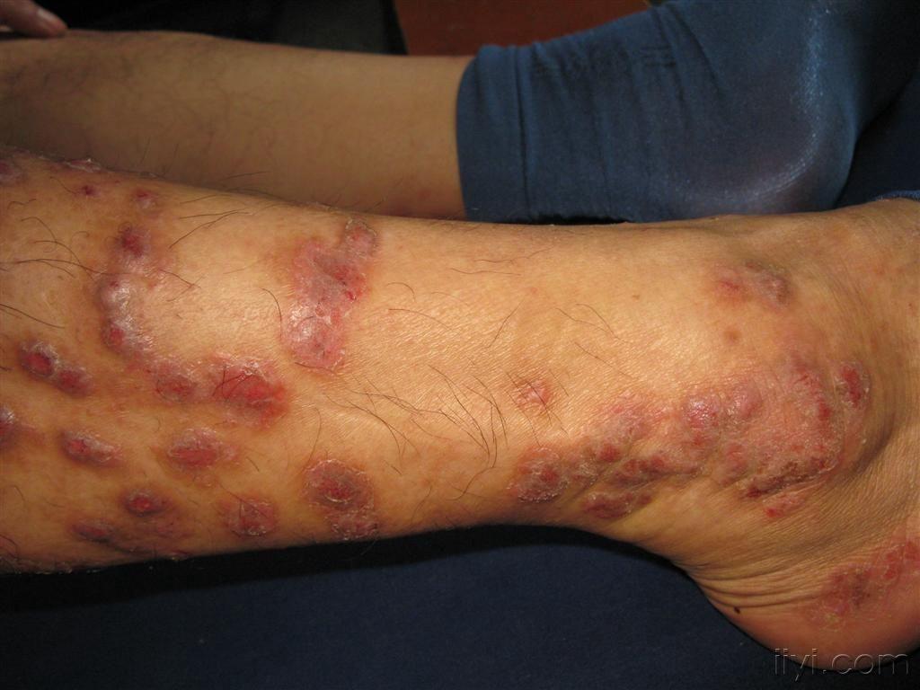结节性痒疹的症状图片