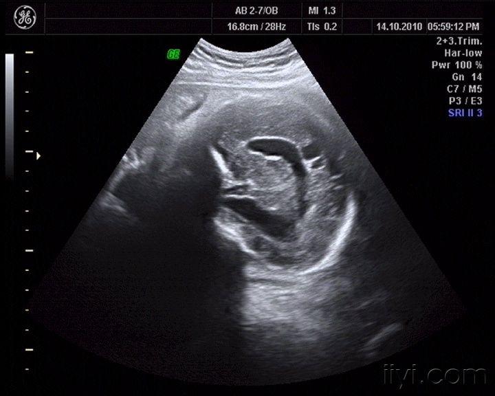 右侧侧脑室体部上方