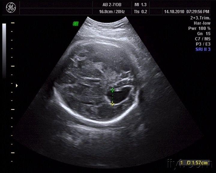 看看这个胎儿颅内情况,见过没有,考虑什么啊