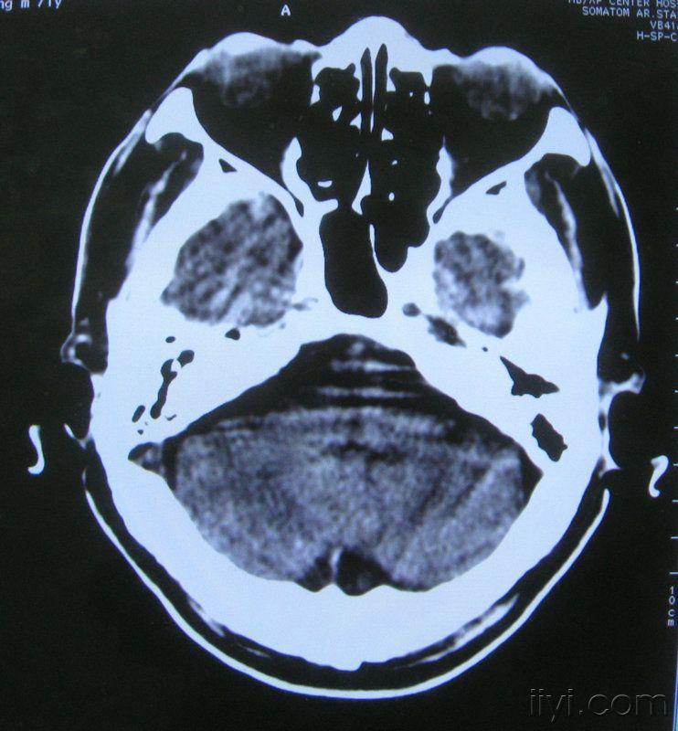 男71歲顱腦ct病史不祥