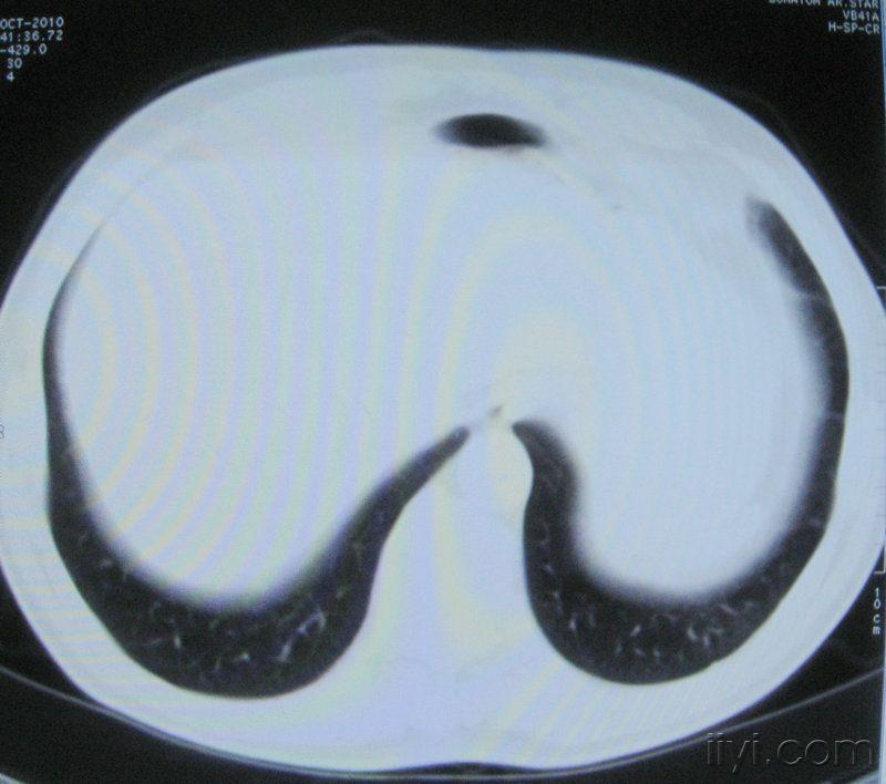 60歲,胸片示支氣管炎治療後複查ct.