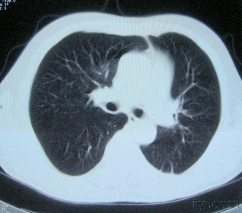 男60歲胸片示支氣管炎治療後複查ct