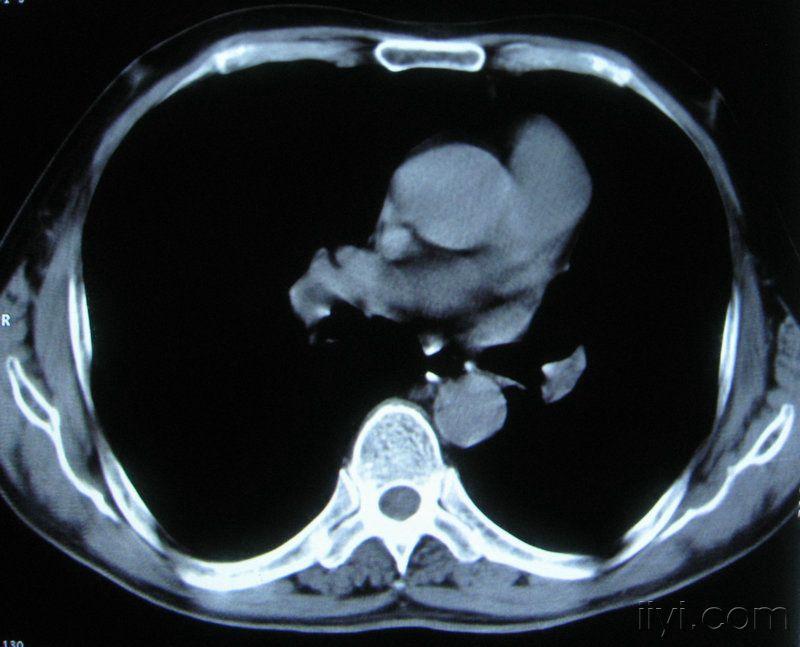 男60歲胸片示支氣管炎治療後複查ct