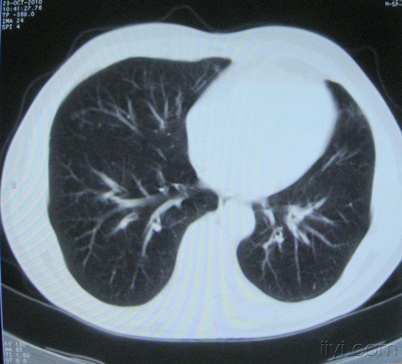 60歲,胸片示支氣管炎治療後複查ct.