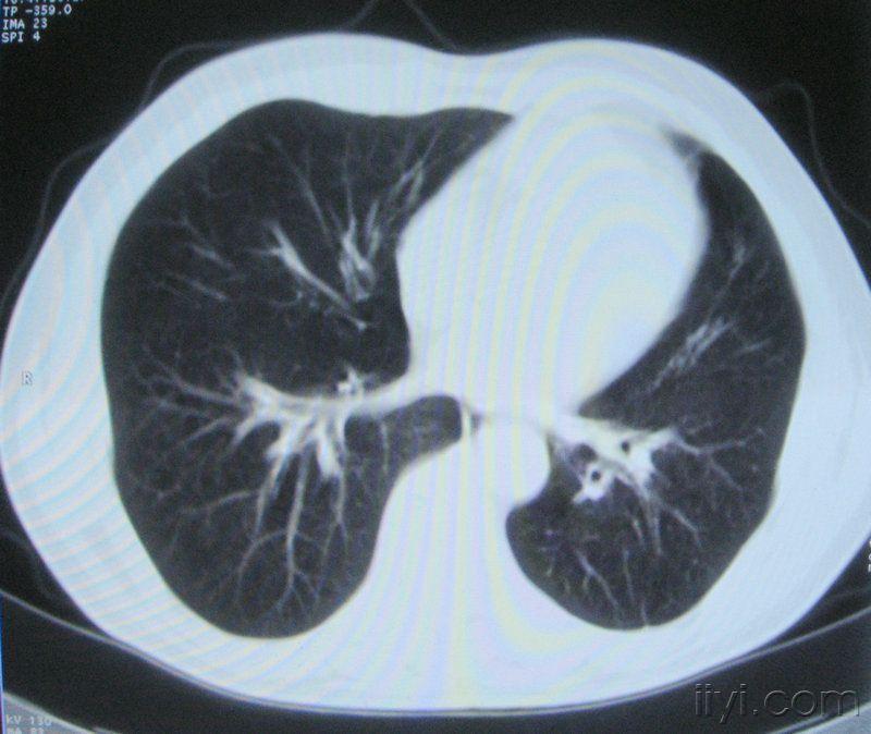 男60歲胸片示支氣管炎治療後複查ct