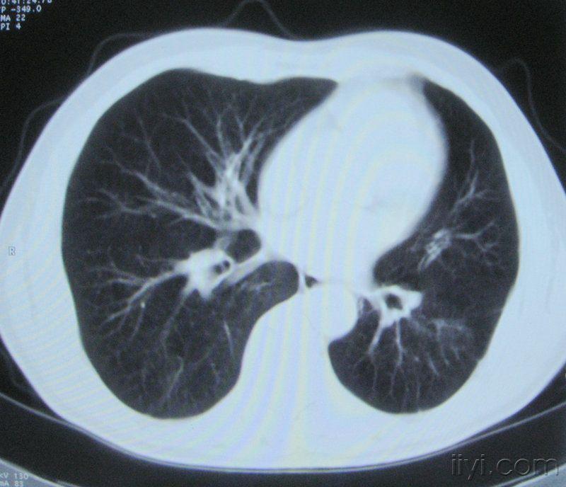 支气管胸片图片