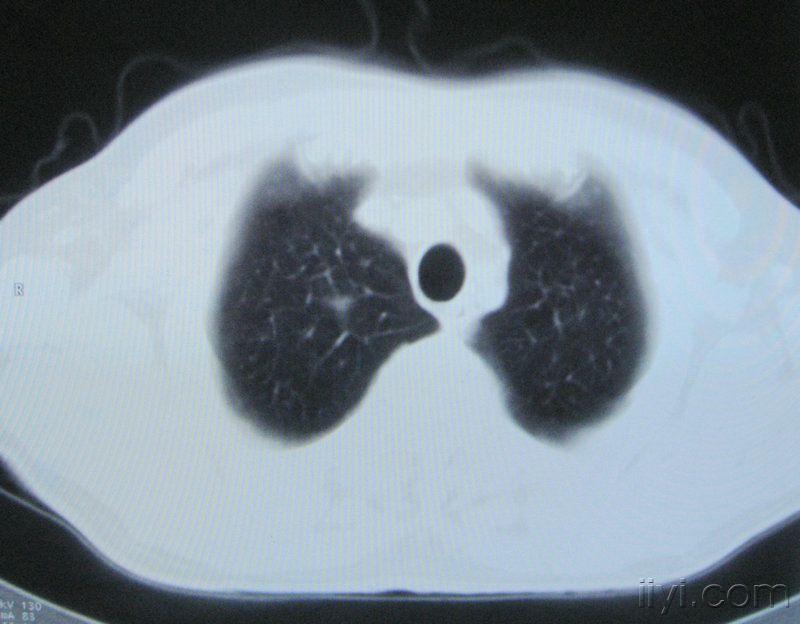 男60歲胸片示支氣管炎治療後複查ct