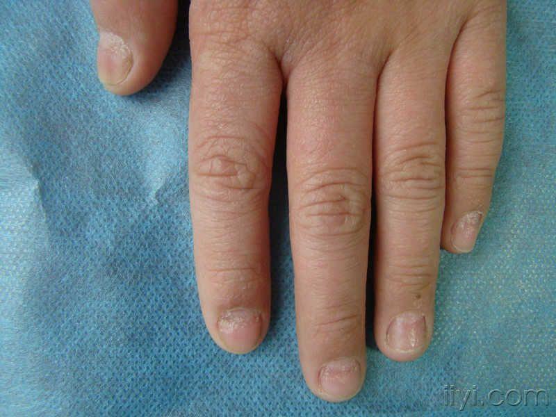 皮肌炎指甲表现图片图片