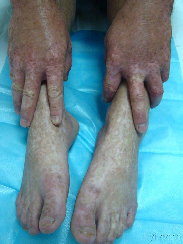 双手足背色素沉着减退斑遗传性对称性色素异常症