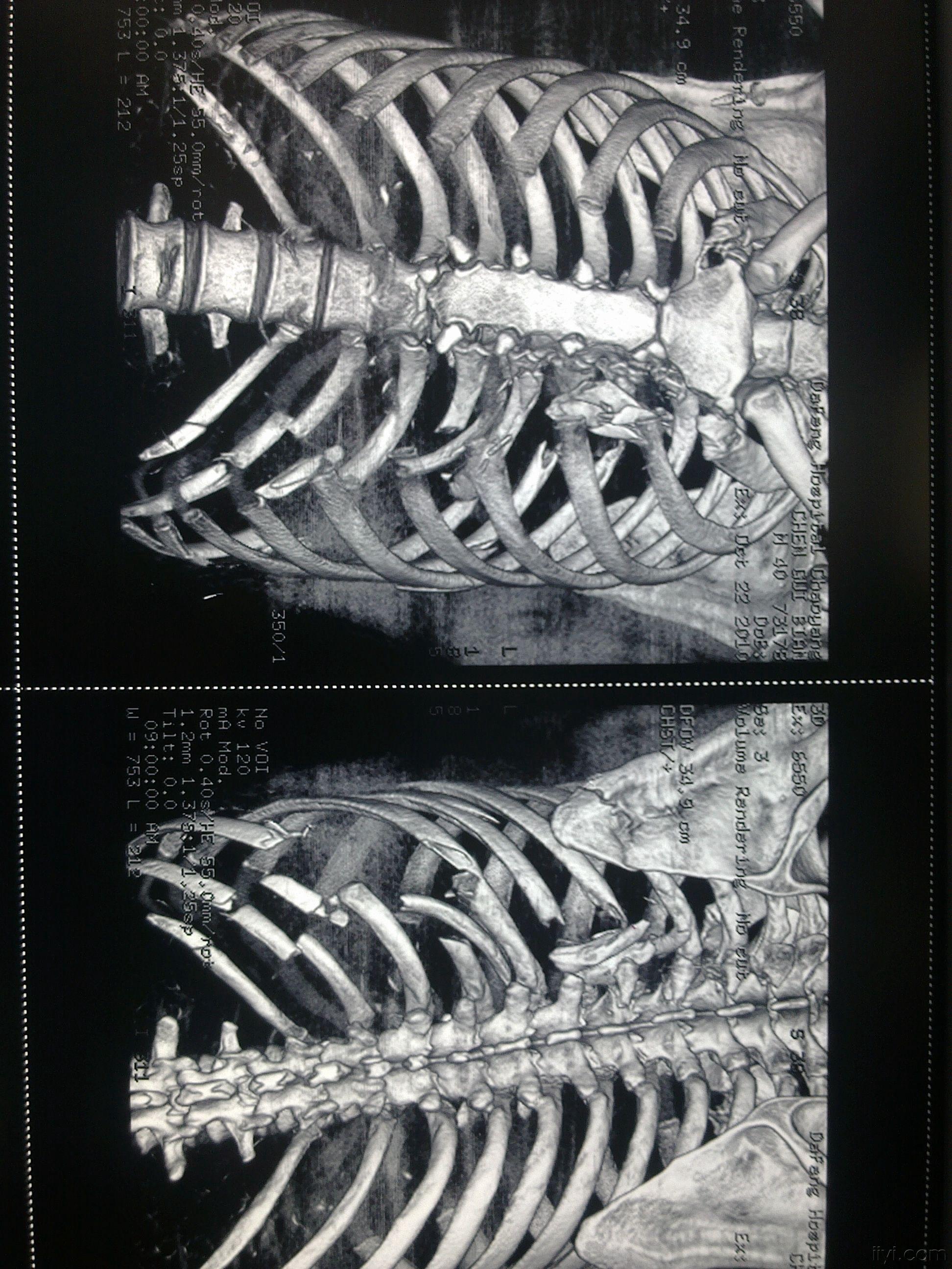 多發性肋骨骨折創傷性溼肺術後肺積血治療討論(付經典肋骨重建圖片)