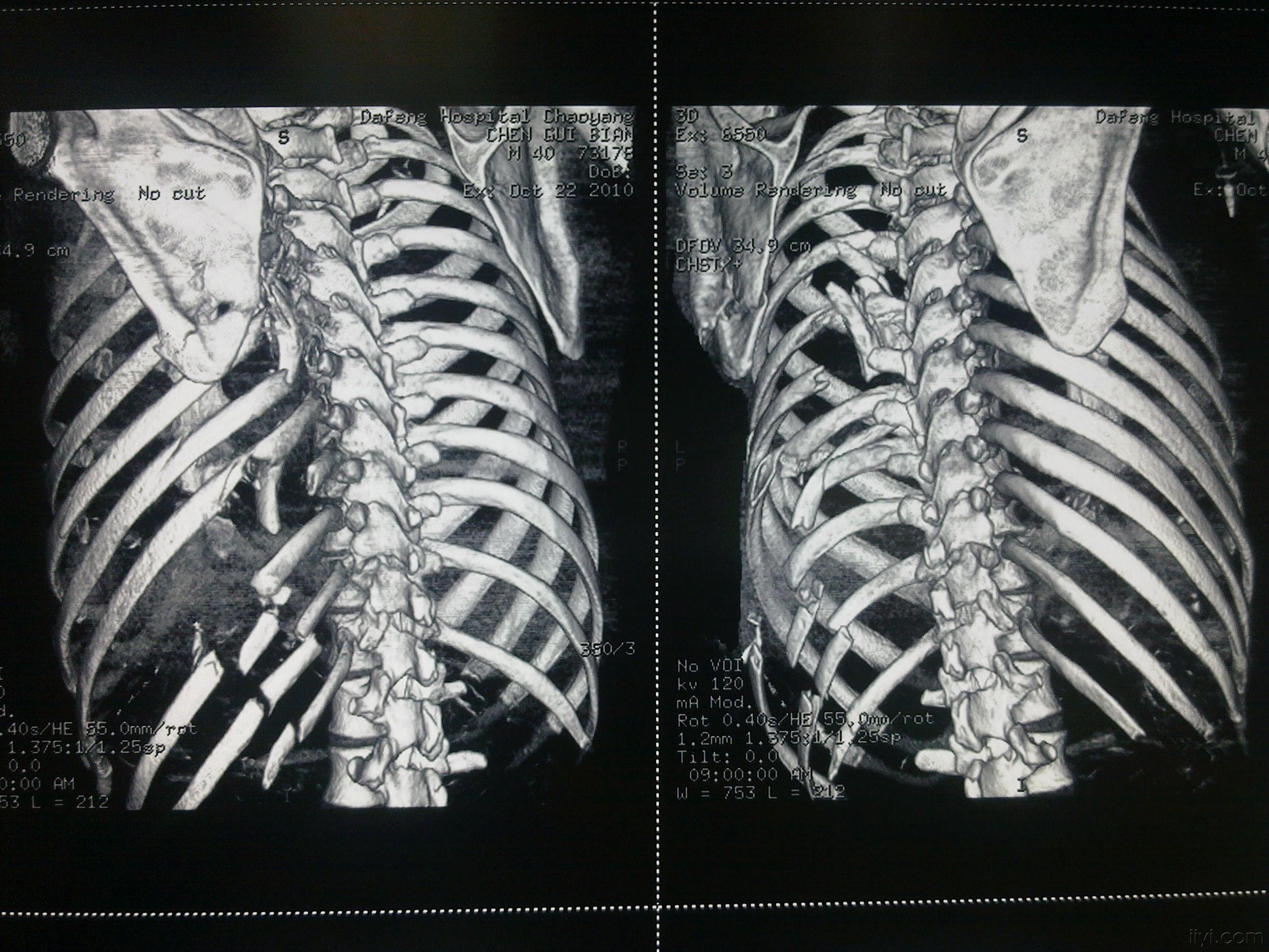 肋骨骨折十级伤残图片图片