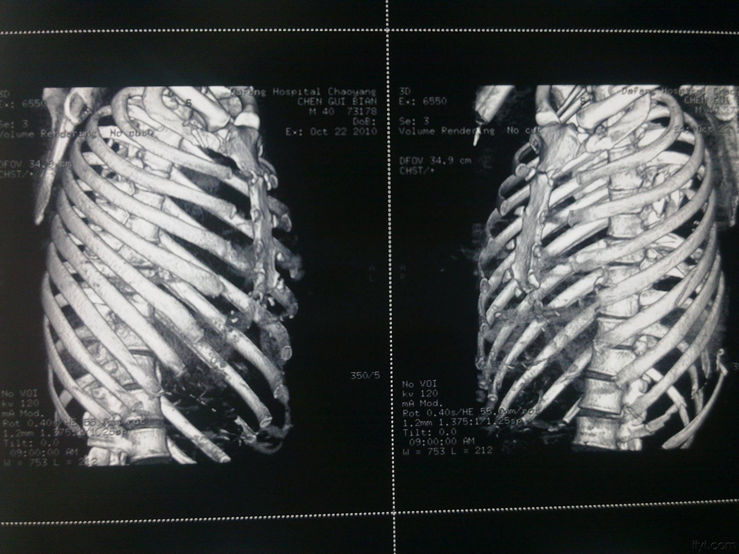 多發性肋骨骨折創傷性溼肺術後肺積血治療討論(付經典肋骨重建圖片)