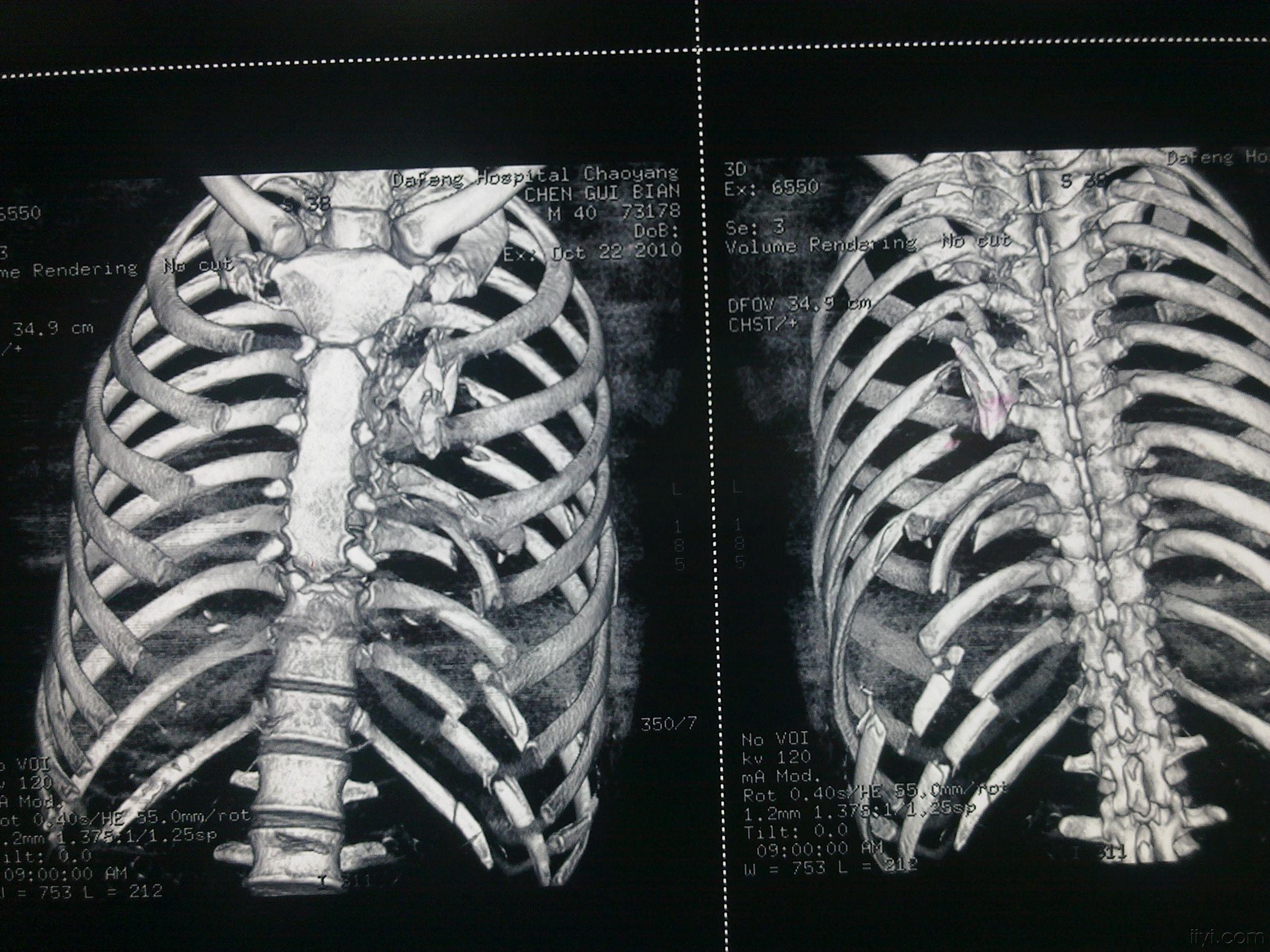 肋骨核磁图片