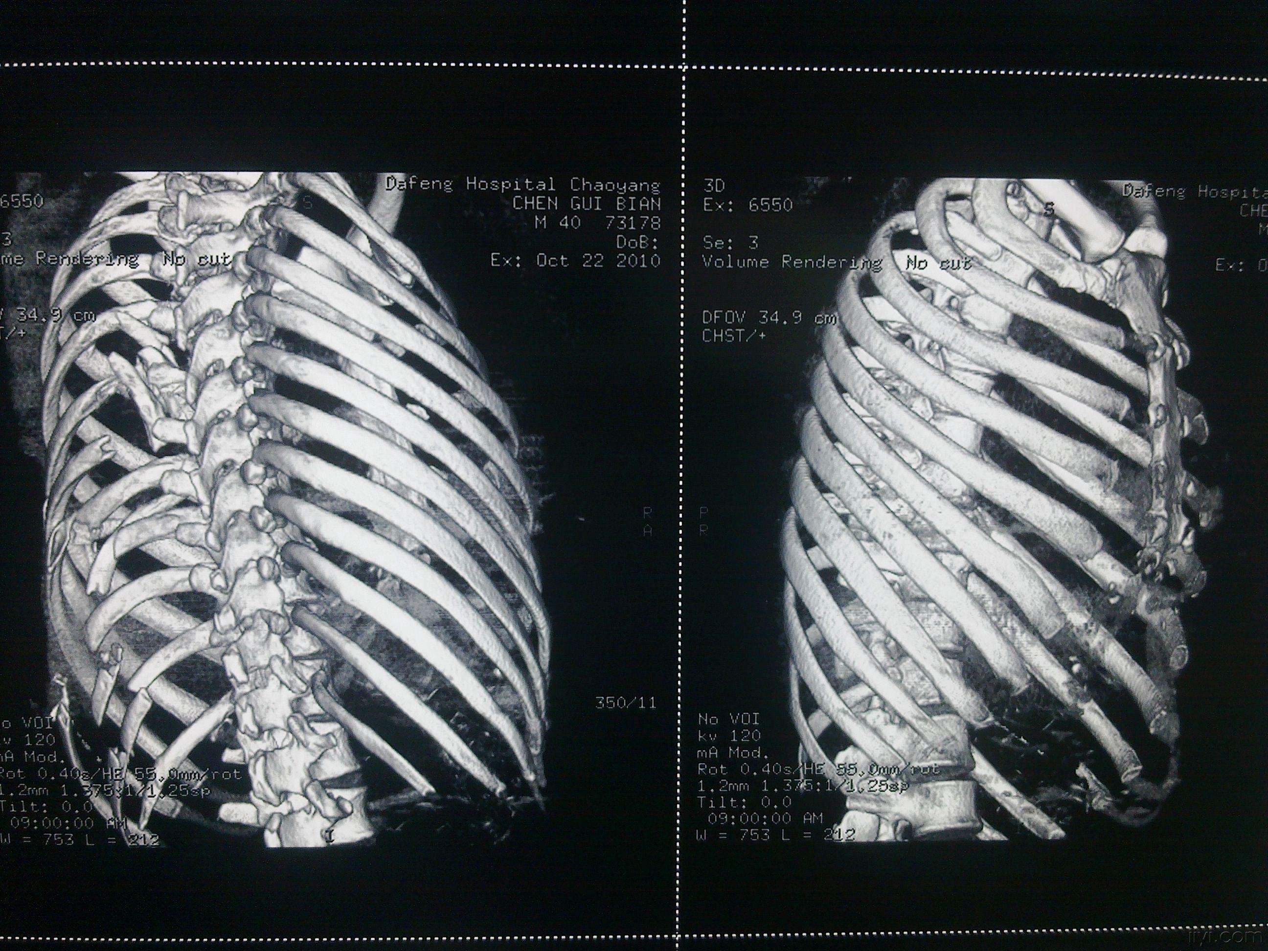 肋骨骨折断端重叠（详见CT报告单、图片）._百度知道