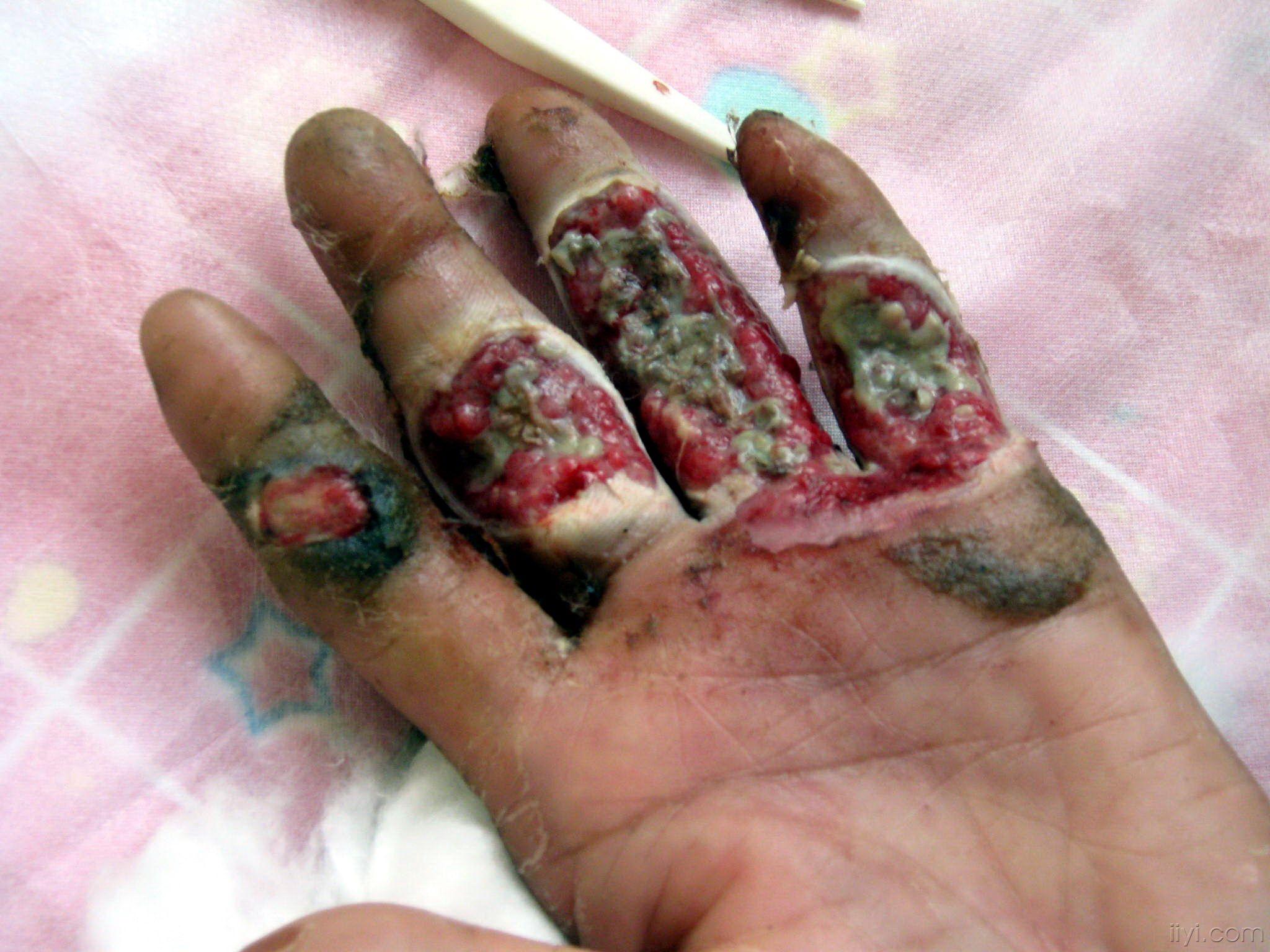 伤愈膏的功效主要对长期不愈合的伤口骨外露烧伤有独特的疗效