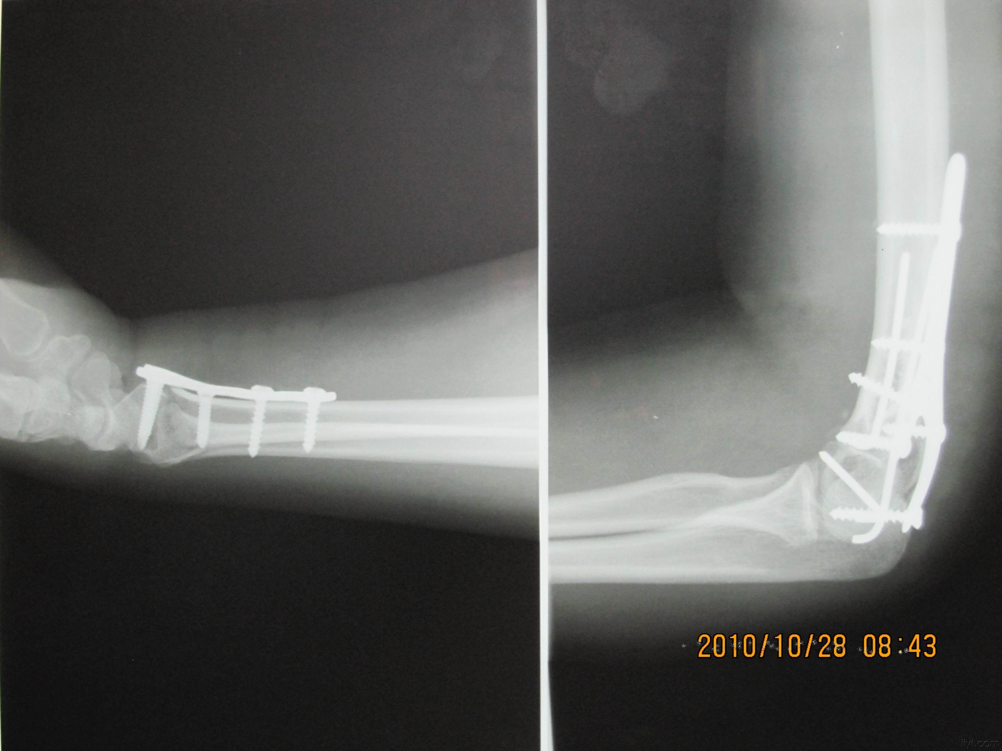 肱骨髁间开放性粉碎性骨折手术做的如何请讨论