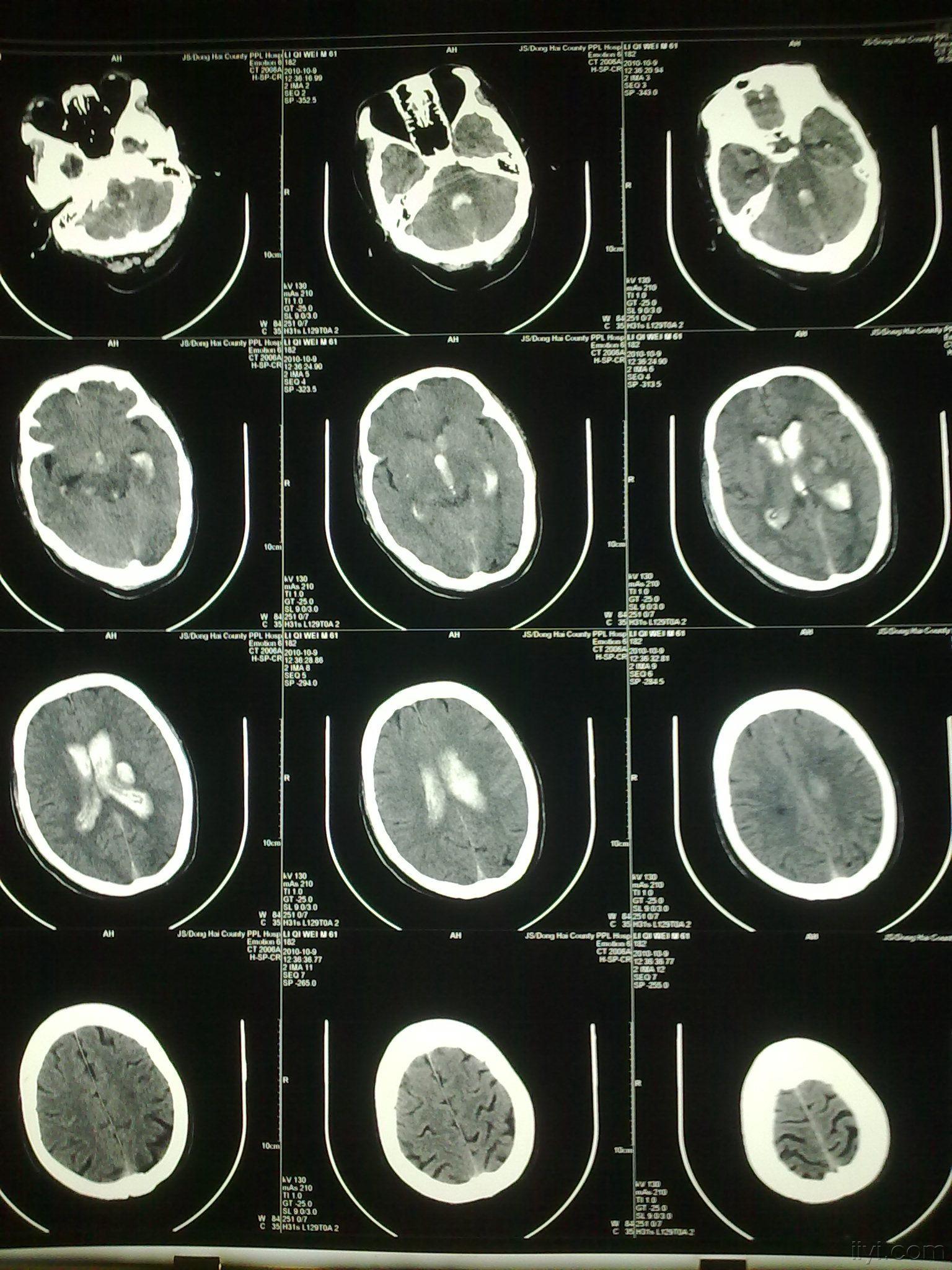 一例比较看似简单而又复杂的脑室铸型 - 神经外科专业讨论版 - 爱爱医