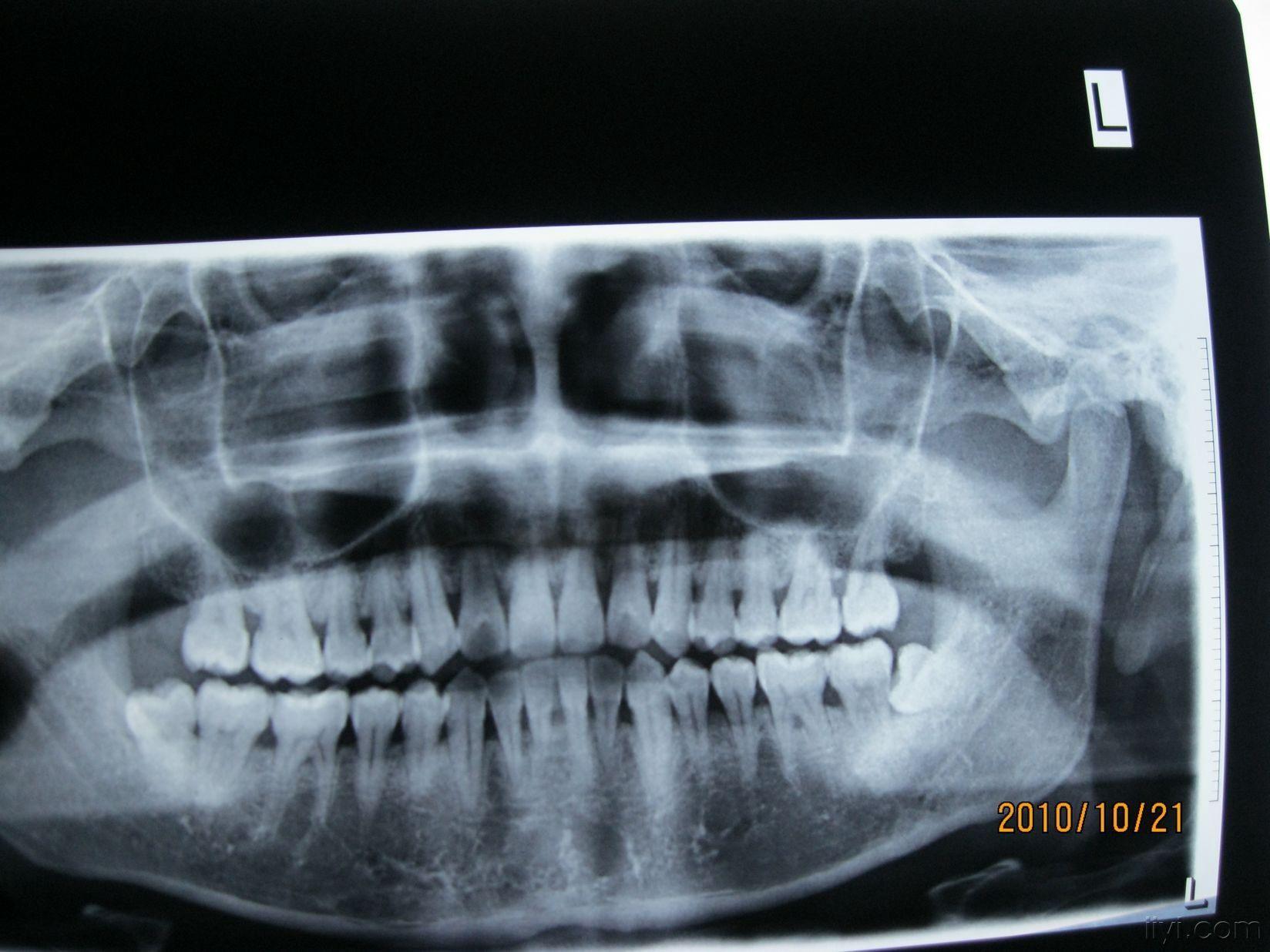 牙龈上的突起是什么