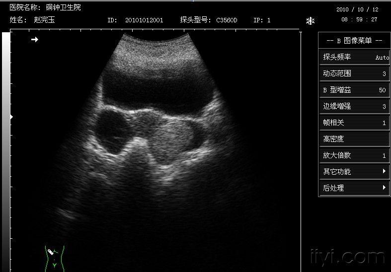 考慮左側附件區畸胎瘤,右側附件囊腫