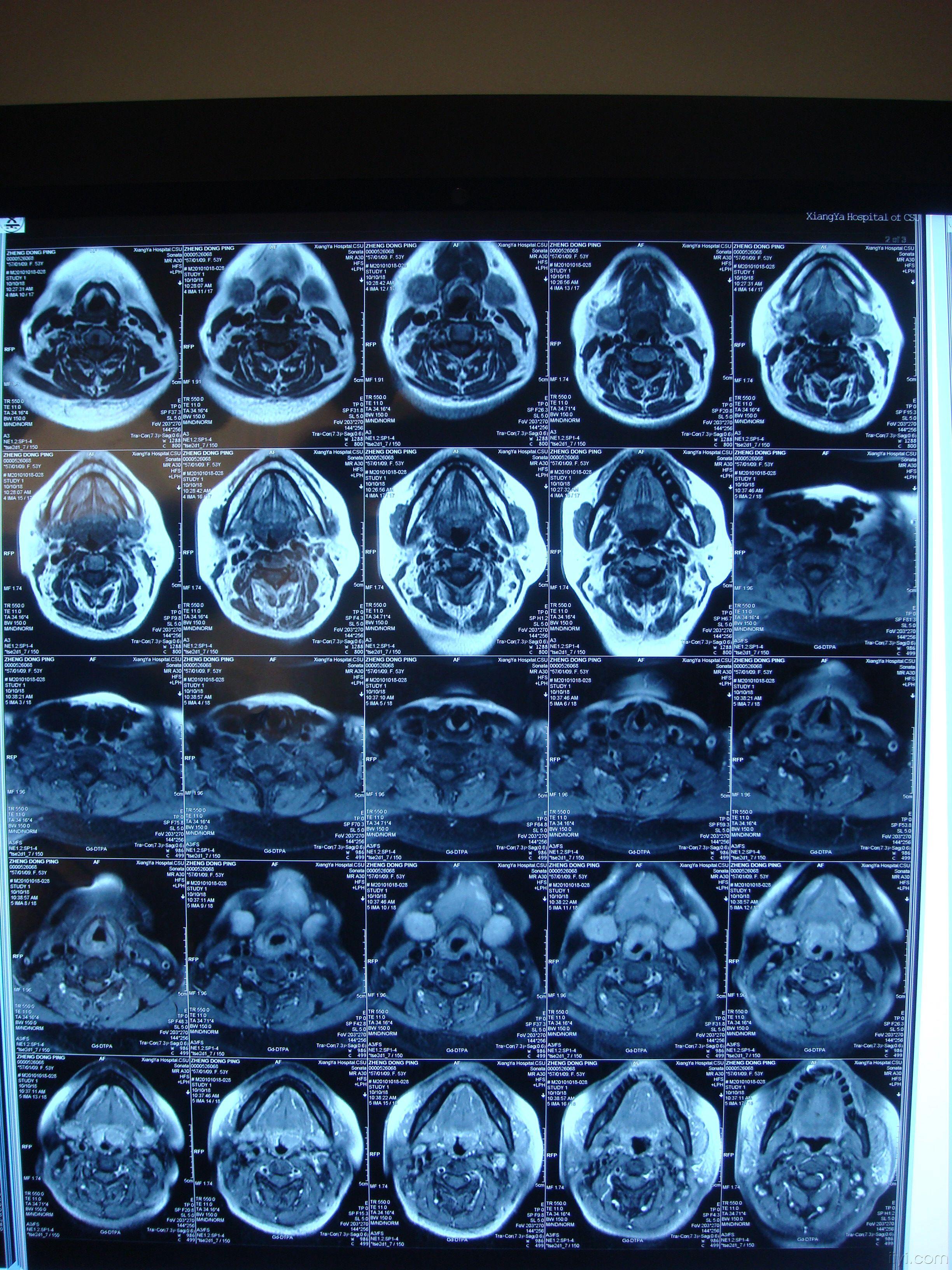 求舌根肿物的治疗方案急急急