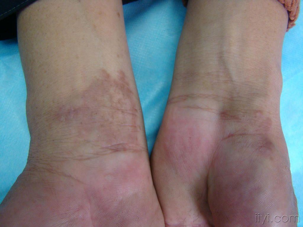 双手背,腕部斑块-----环状肉芽肿