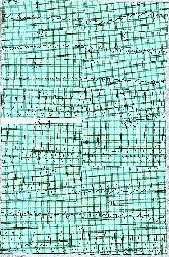 预激伴房颤?房颤伴差传蝉联?短阵室速?