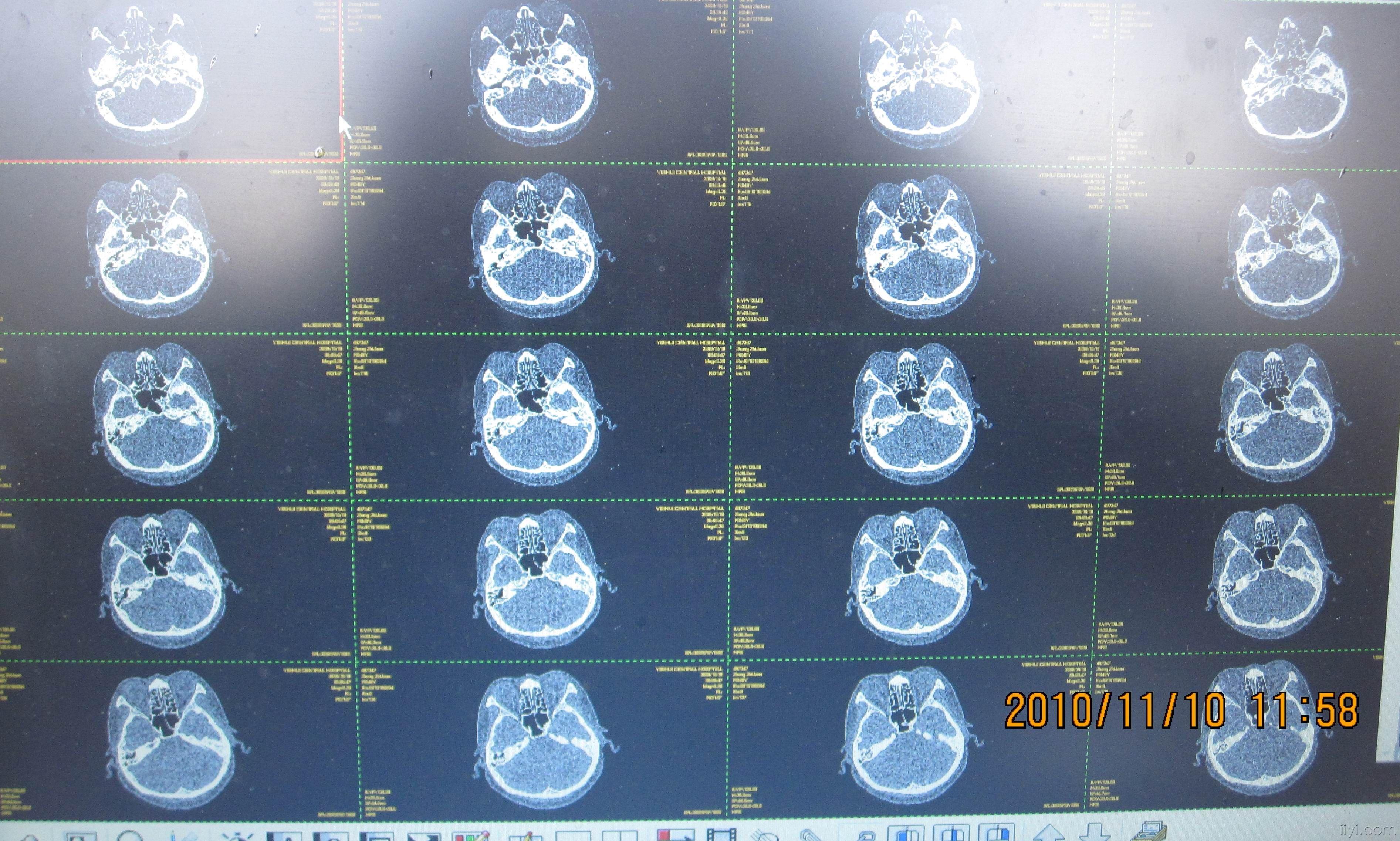 【2010-32】耳鼻喉版原创病例讨论第一季--左乳突炎症假瘤(淋巴瘤)