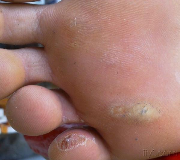 手足脱皮1周 皮肤及性传播疾病讨论版 爱爱医医学论坛 手足脱皮1周 皮肤及性传播疾病讨论版 爱爱医医学论坛