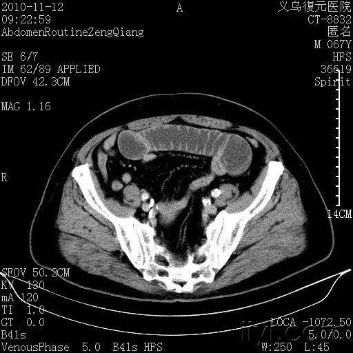 肠梗阻的原因,请大家指点下 - 医学影像学讨论版 - 爱爱医医学论坛