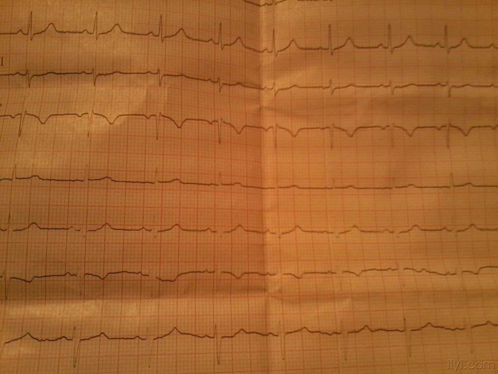 房性逸搏心电图图片