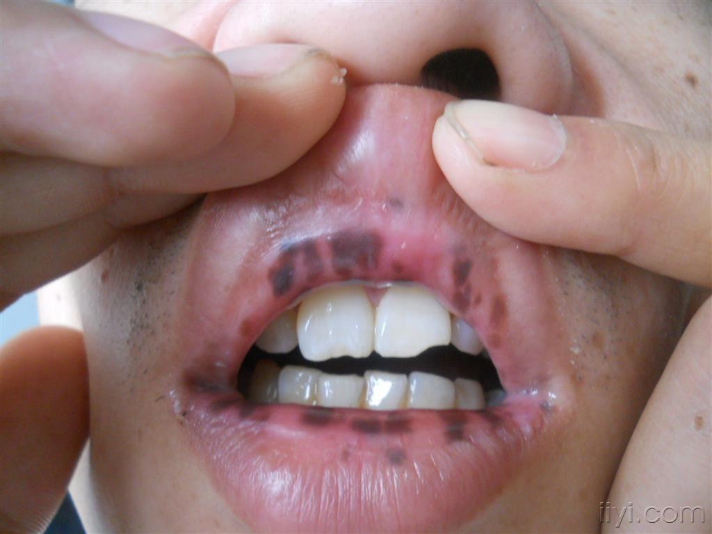 唇部皮损无胃肠道症状