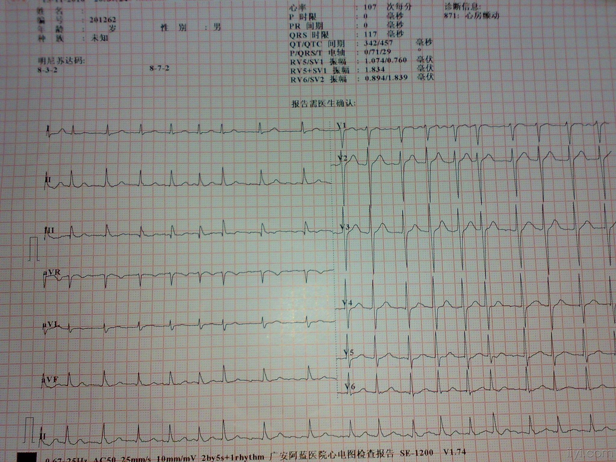 阵发性心房颤动心电图图片