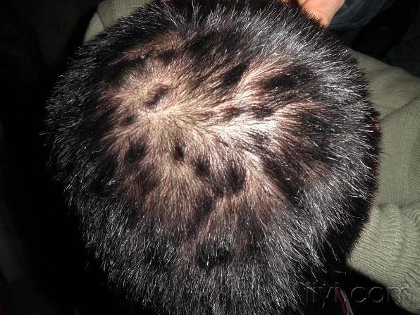 银屑病头发成束状图片图片