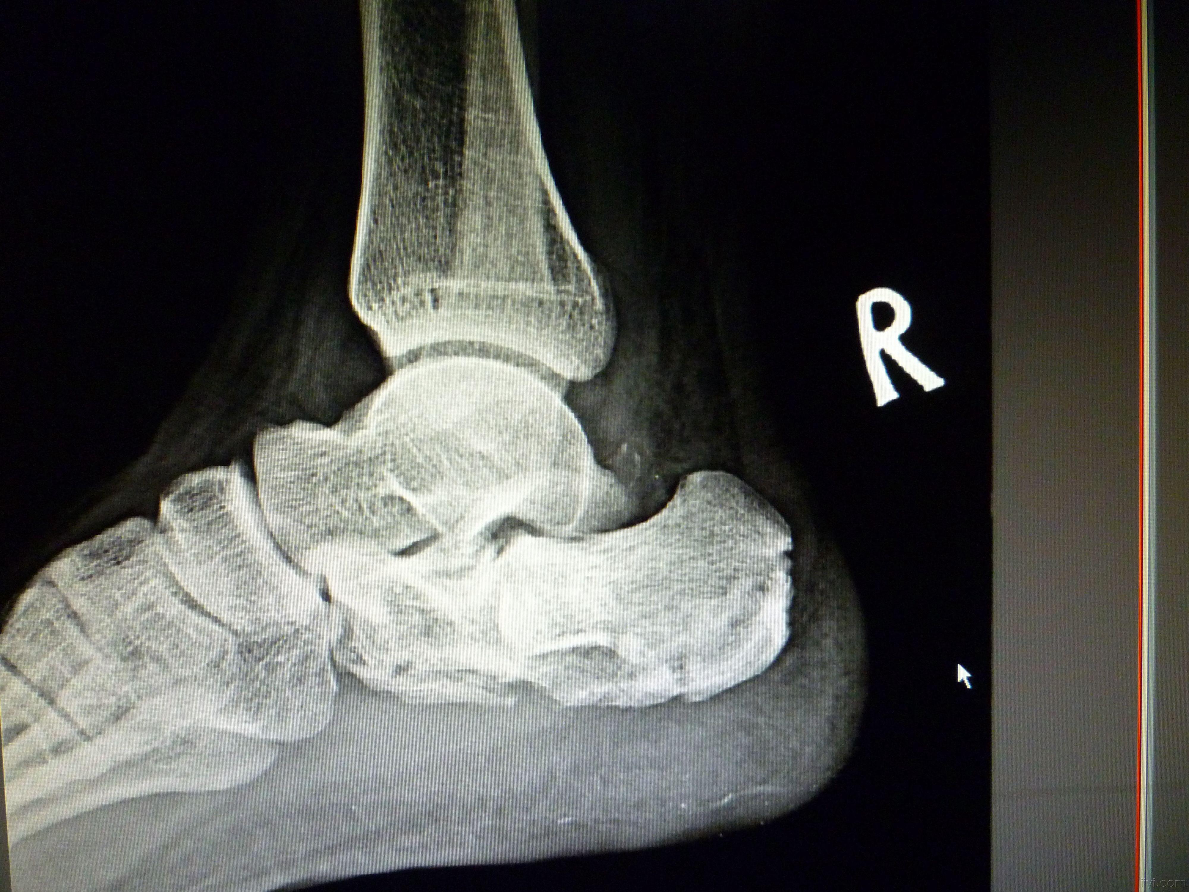 跟骨骨折术后请赐教