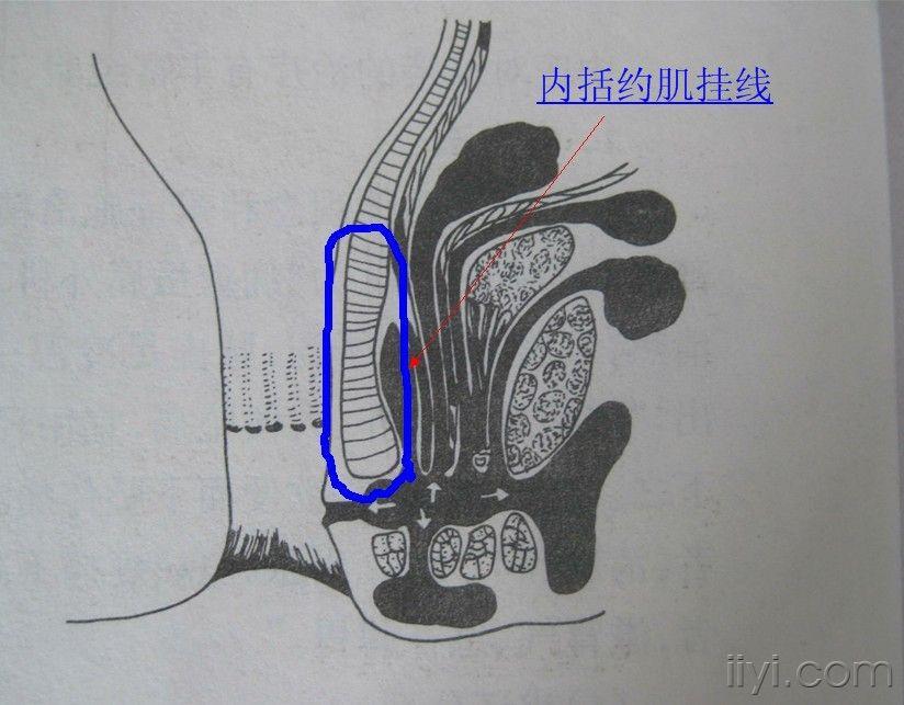 肛周脓肿挂线手术图解图片