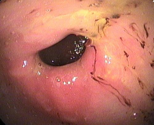 胃溃疡胃镜照片图片