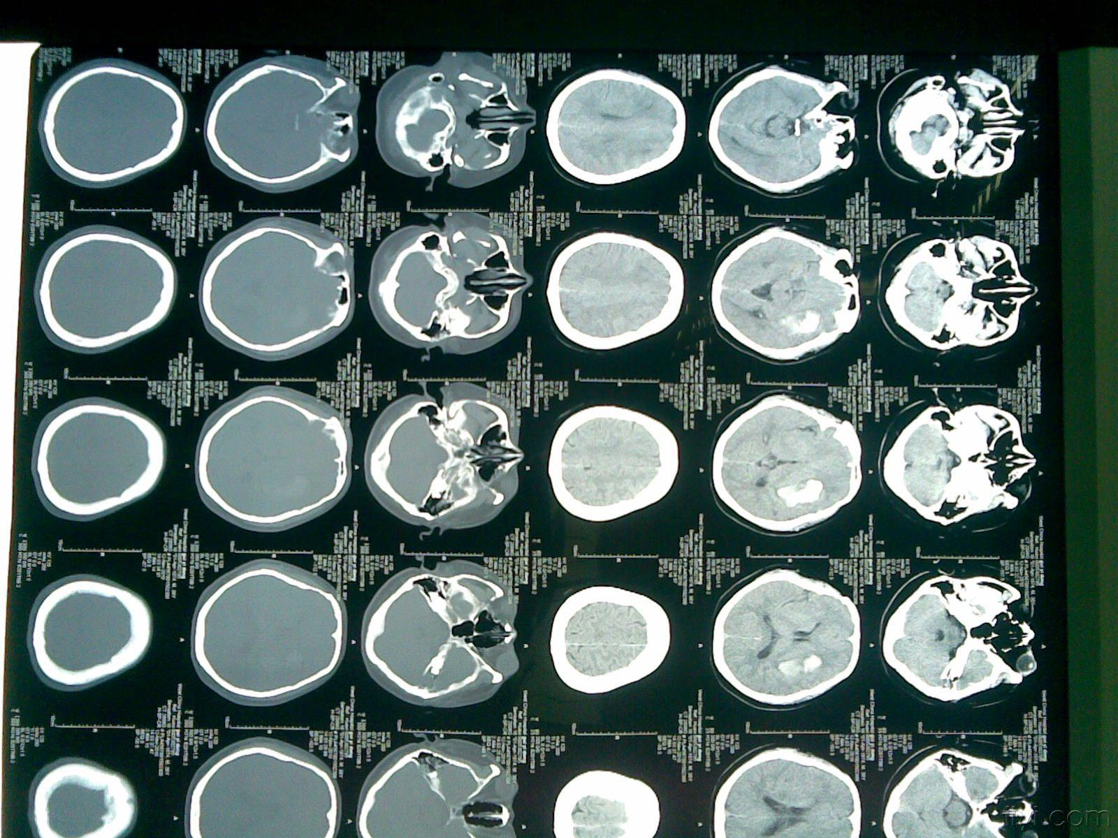 是avm还是高血压脑出血