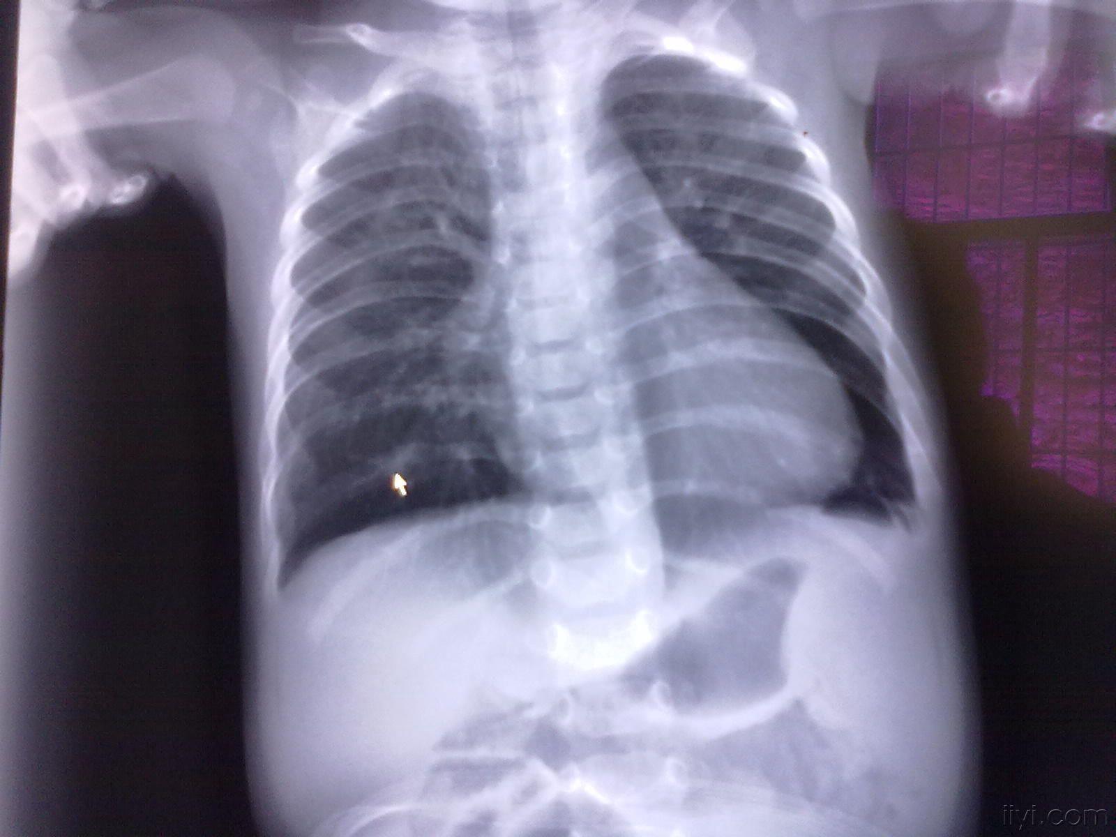 复件 右侧小叶性肺炎伴左肺气肿.jpg