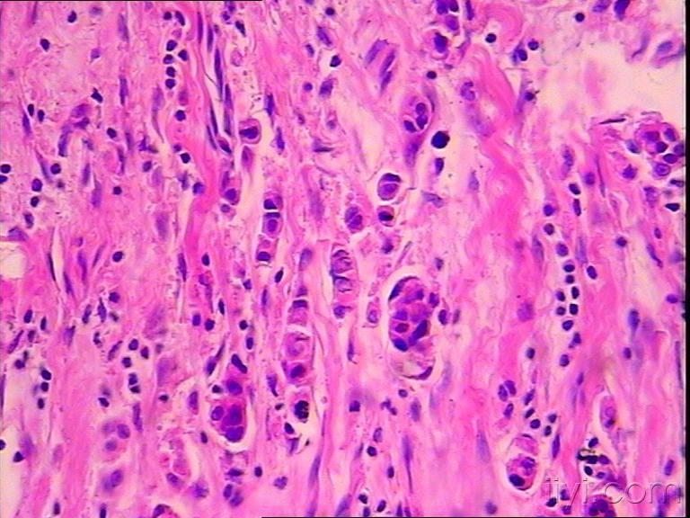 20101123女28岁右乳腺肿物