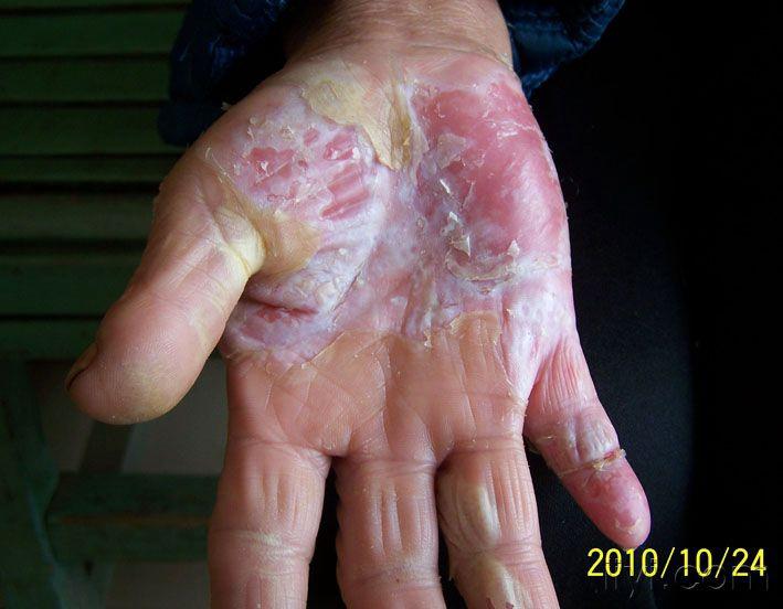 重症角质松解症?罕见!有图!