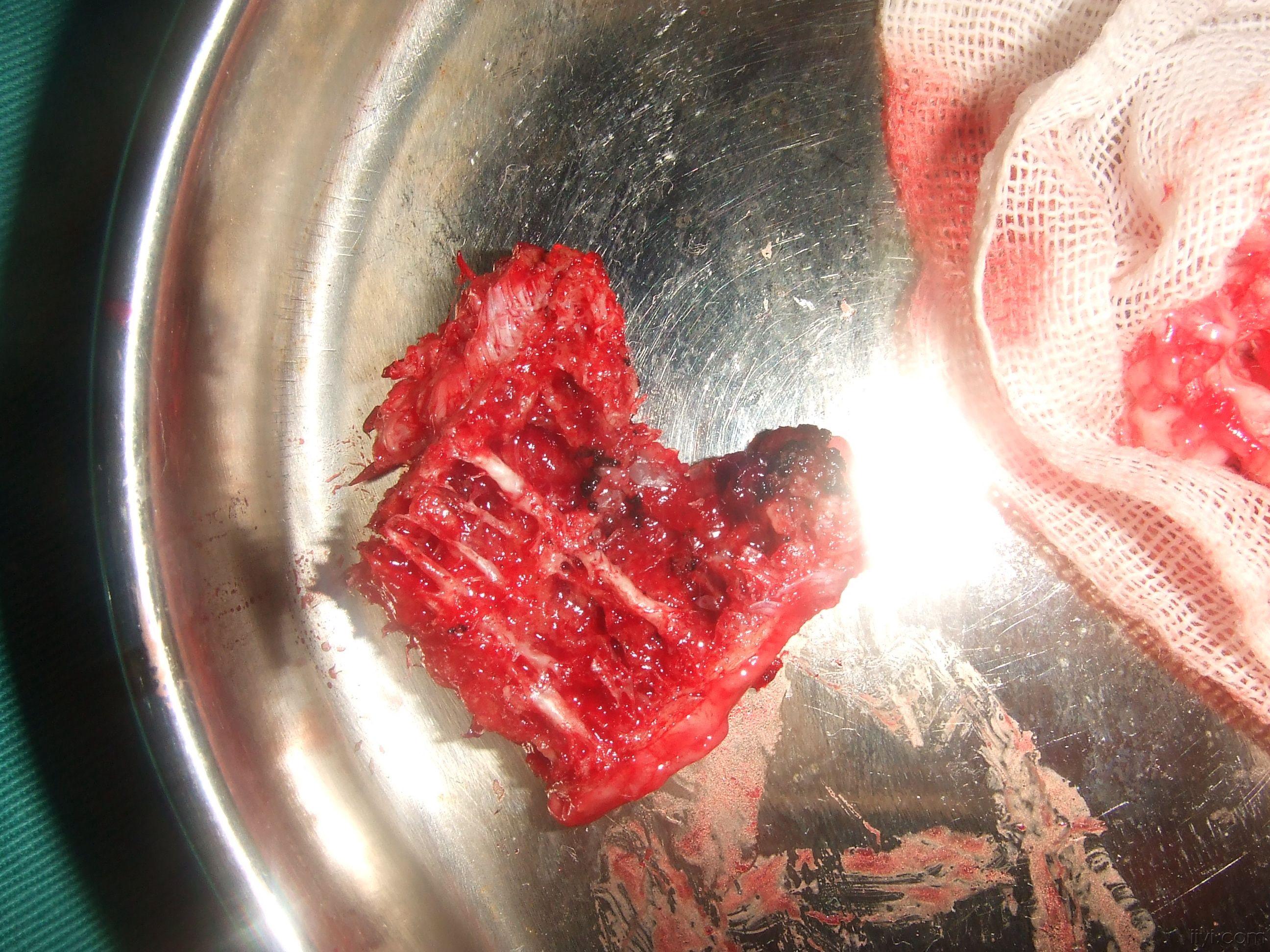 腰1椎体血管瘤一例,手术方式探讨.