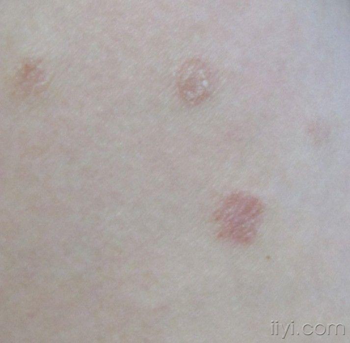 请看看是银屑病还是玫瑰糠疹