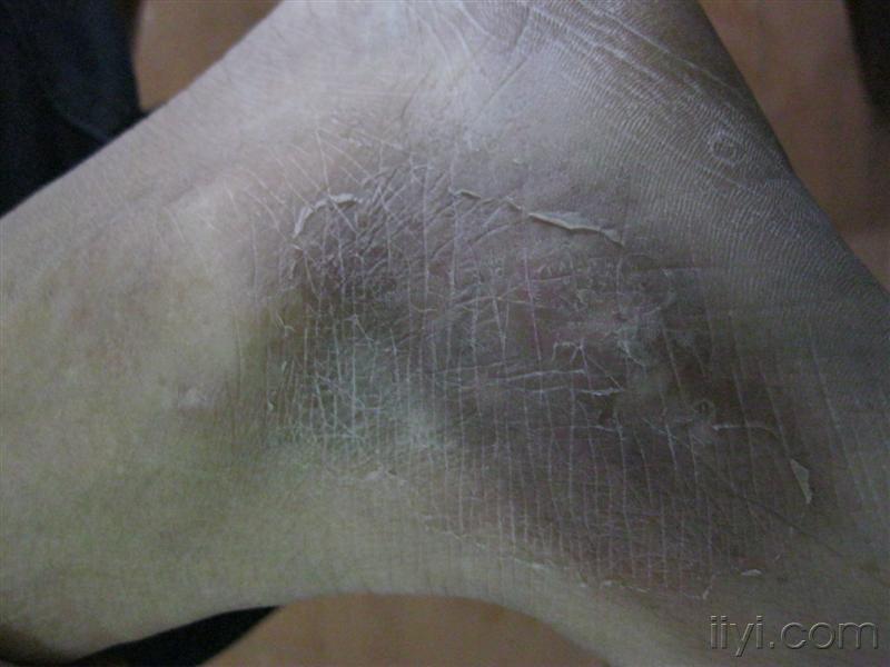 色素沉着是什么原因造成的呢 10113019418d9875491a336bb7.jpg