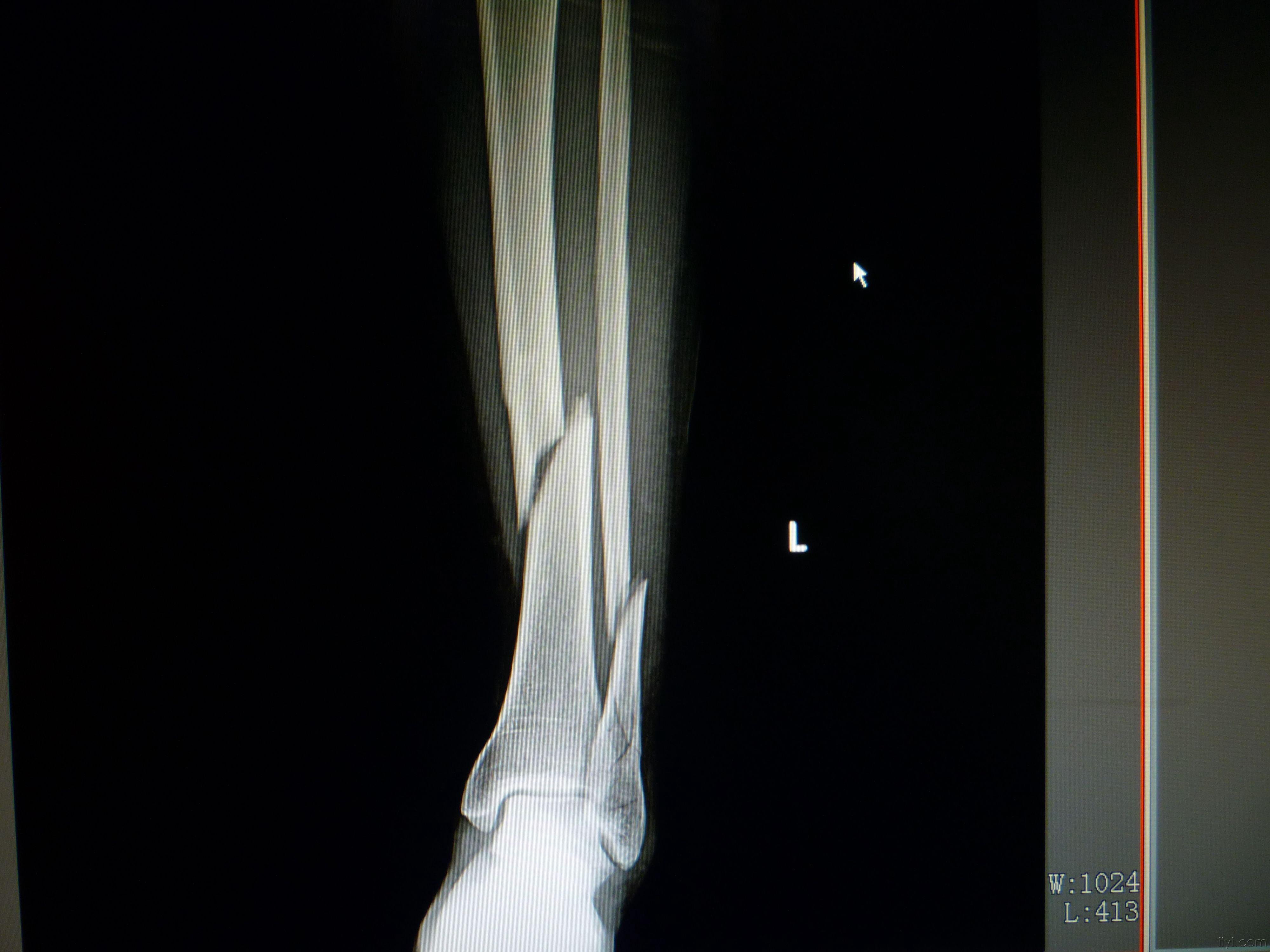 左胫骨远端骨折图片图片