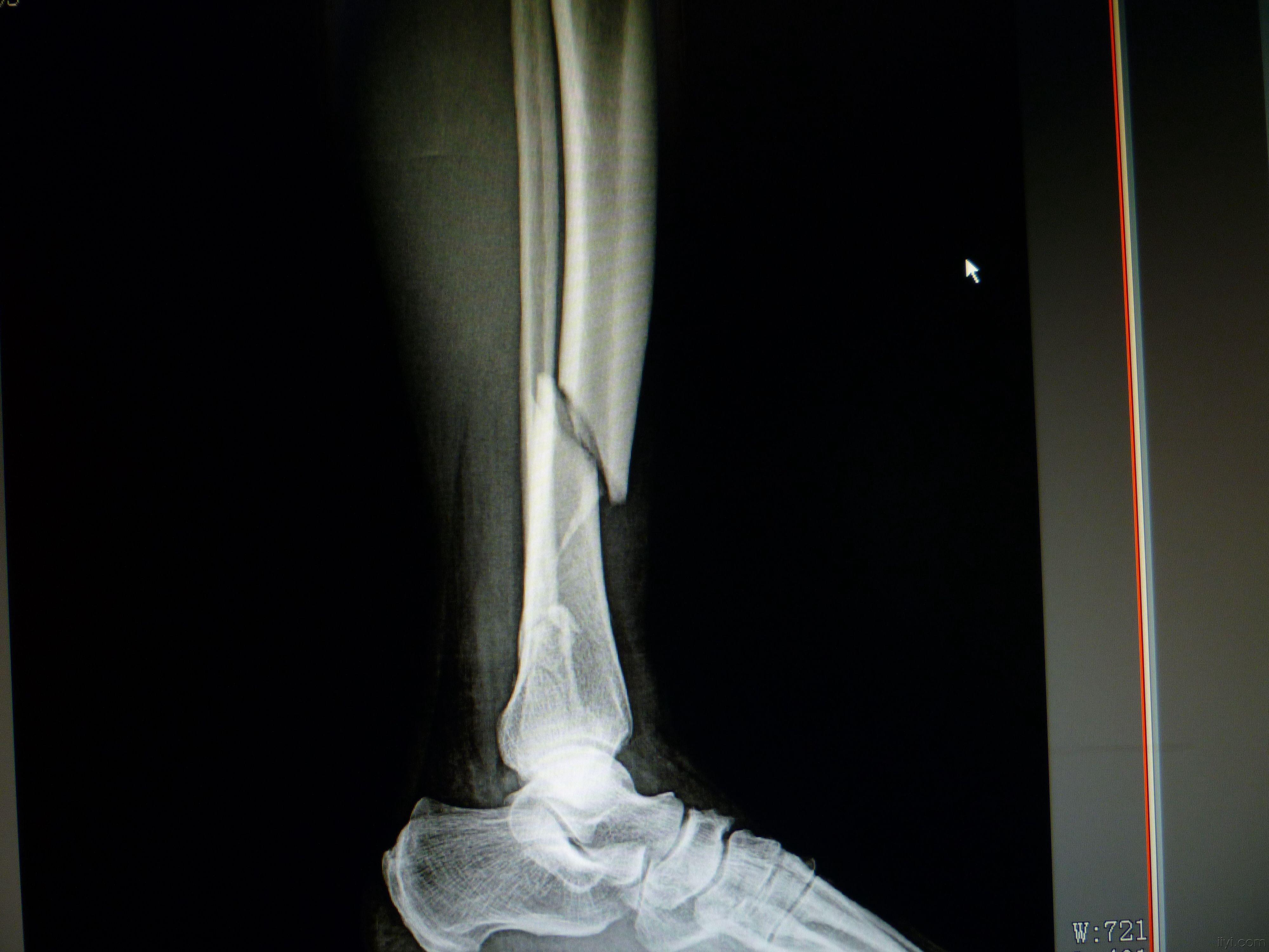 轻微左腿胫骨骨裂图片图片