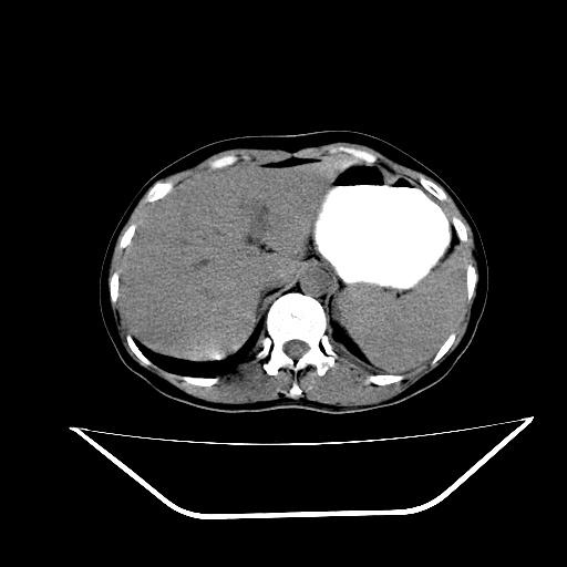 胰头占位ct讨论