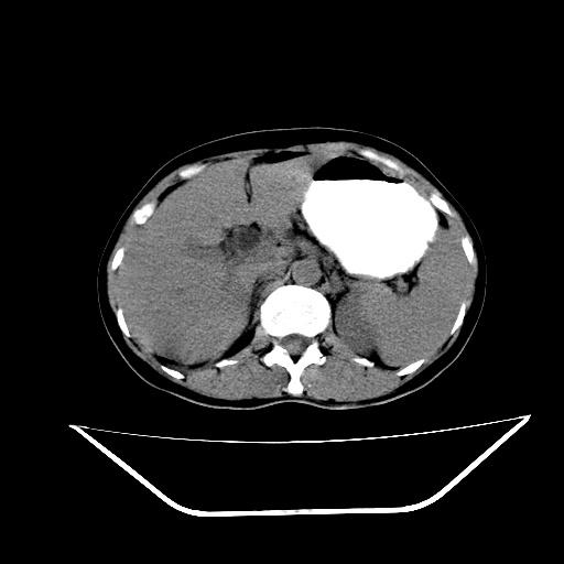 胰头占位?(ct讨论)